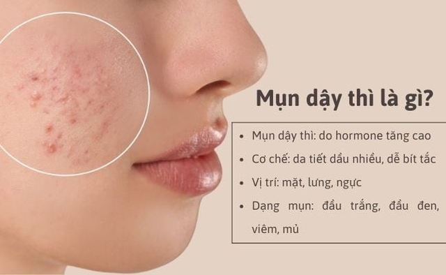 Chuyên gia chia sẻ các bước skincare cho da dầu mụn tuổi dậy thì chuẩn y khoa- Ảnh 2.