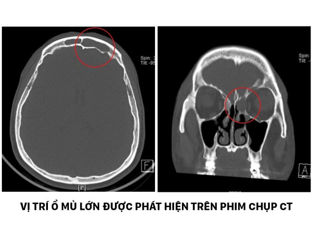 Đau đầu dai dẳng sau mổ xoang, người phụ nữ ph&aacute;t hiện ổ mủ s&aacute;t s&agrave;n sọ - Ảnh 1.