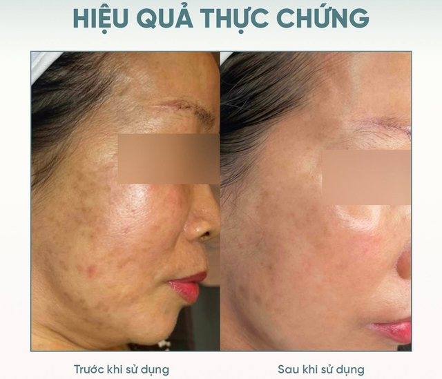 Top 5 kem mờ nám hiệu quả với cả hỗn hợp lâu năm, hết hàng liên tục - Ảnh 1.