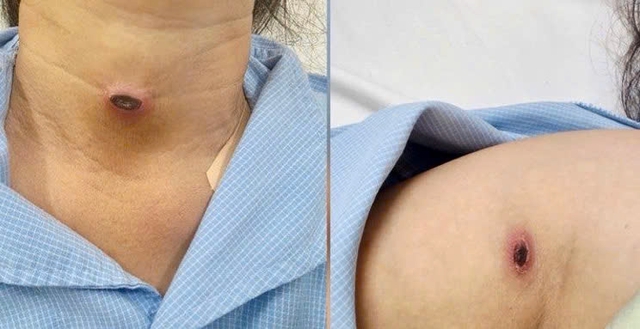 Nhận diện bệnh sốt mò - Ảnh 1.