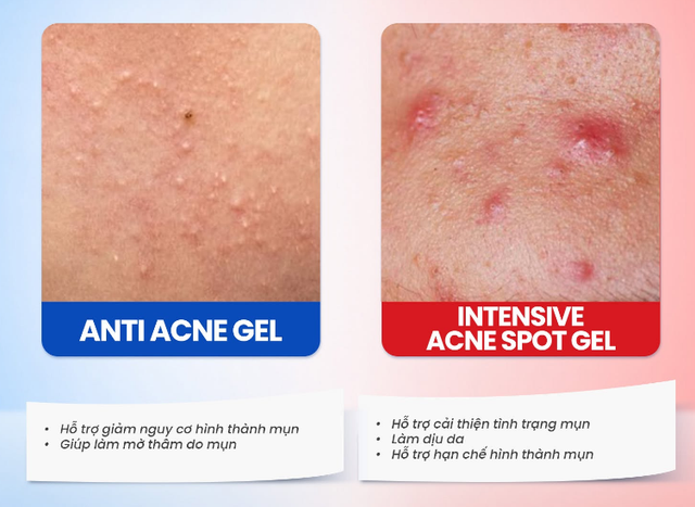 Gel chấm mụn Trioderma hiệu quả với loại mụn nào mà giới skincare đua nhau tìm mua?- Ảnh 1.