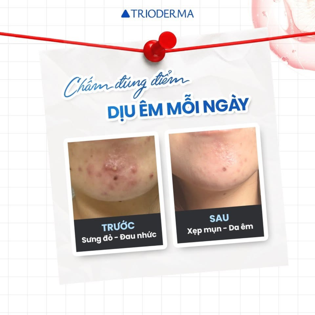Potassium azeloyl diglycinate (PAD) là gì? Tại sao xu hướng không thể thiếu trong điều trị mụn? - Ảnh 10.