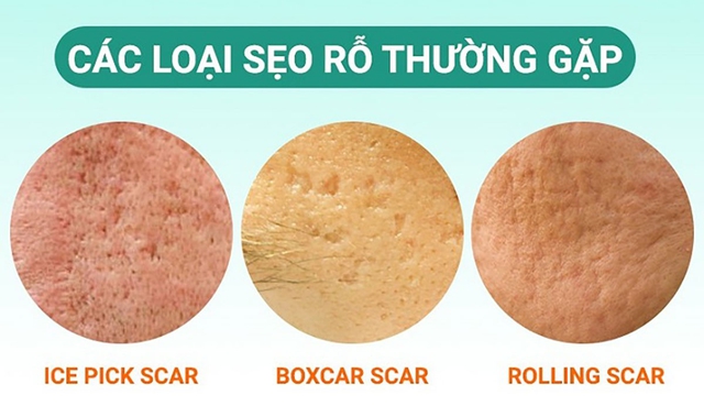 Kem mờ sẹo rỗ nào hiệu quả với cả sẹo lâu năm mà không cần xâm lấn? - Ảnh 2.