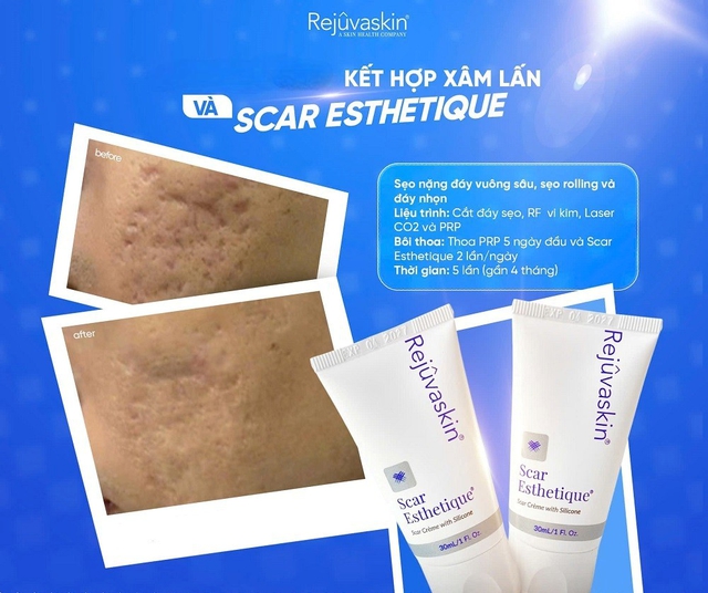 Kem mờ sẹo rỗ nào hiệu quả với cả sẹo lâu năm mà không cần xâm lấn? - Ảnh 9.