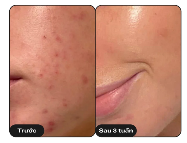 Niacinamide đang hot trở lại: Dùng thế nào để vừa giảm dầu vừa hỗ trợ sáng da? - Ảnh 3.