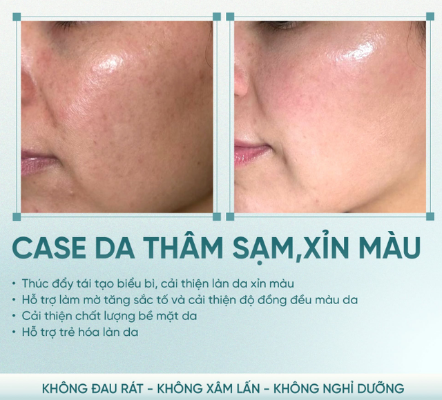 +5 serum mờ nám mảng, nám chân sâu; hiệu quả cả nám lâu năm không xâm lấn - Ảnh 1.