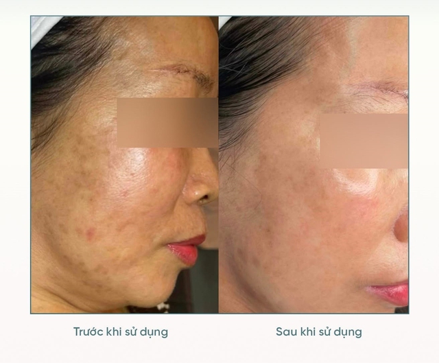 +5 serum mờ nám mảng, nám chân sâu; hiệu quả cả nám lâu năm không xâm lấn - Ảnh 7.