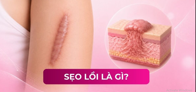 Kem mờ sẹo lồi có thật sự hiệu quả với những tổn thương trên 1 năm không? - Ảnh 2.