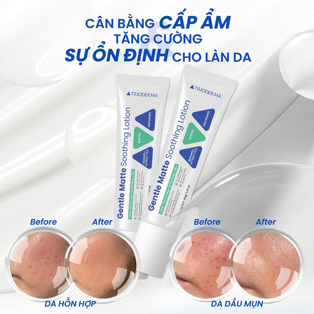 Da dầu mụn có nên dưỡng ẩm? Tìm lời giải cho làn da dễ bí, kích ứng - Ảnh 6.