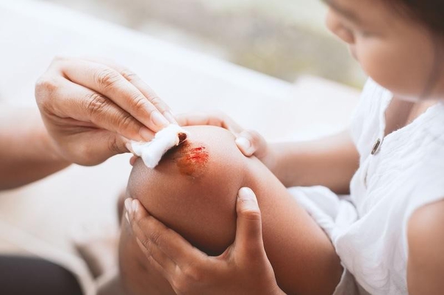  7 bước xử l&yacute; vết thương trong 24 giờ đầu hạn chế nguy cơ nhiễm tr&ugrave;ng, sẹo xấu - Ảnh 3.