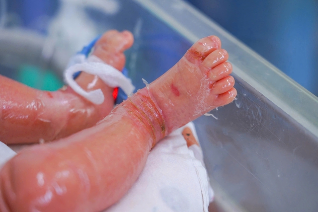 Bé sinh non mắc bệnh vảy cá hiếm gặp, hồi phục sau 12 ngày điều trị - Ảnh 1.