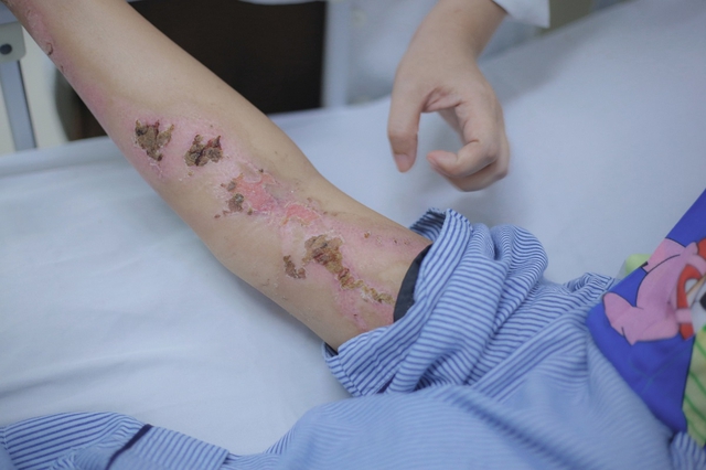Tr&ecirc;n đường đi l&agrave;m về, người phụ nữ bị s&eacute;t đ&aacute;nh ng&atilde; gục, bỏng nặng  - Ảnh 1.