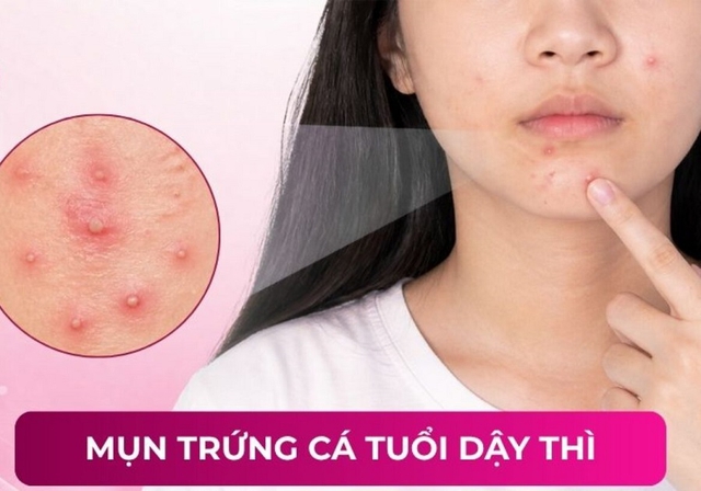 Bất ngờ kem giảm mụn tuổi dậy thì được phụ huynh tìm mua nhiều ‘made in VietNam’ - Ảnh 2.