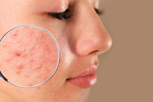 Da dầu mụn, mụn viêm sưng nên dùng gì? Gợi ý routine chuẩn y khoa từ Trioderma- Ảnh 1.