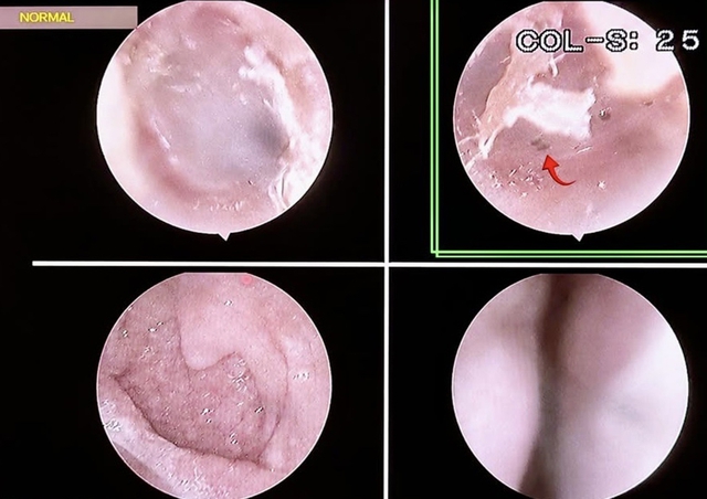 Bọ chét 'làm tổ' trên người: Dấu hiệu và cách phòng tránh - Ảnh 2.