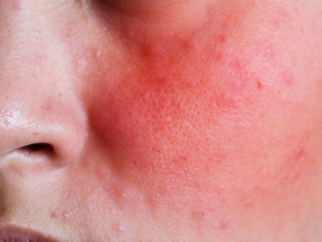 Giải b&agrave;i to&aacute;n &lsquo;nghỉ dưỡng d&agrave;i ng&agrave;y&rsquo; bằng ph&aacute;c đồ Plasma lạnh- Ảnh 2.