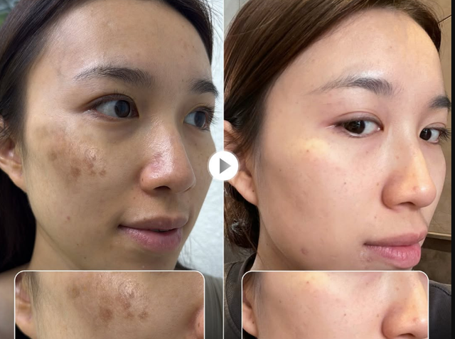 Top 3 kem gi&uacute;p mờ n&aacute;m ch&acirc;n đinh, đốm n&acirc;u l&acirc;u năm v&agrave; kh&ocirc;ng lo t&aacute;i ph&aacute;t - Ảnh 1.