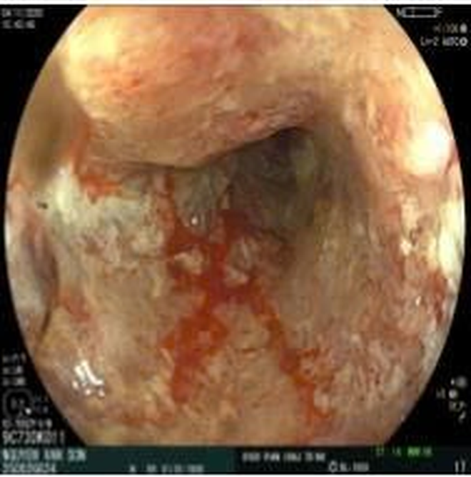 Phát hiện sớm ung thư đại tràng nhờ nội soi tại Bệnh viện ĐHYK Phan Châu Trinh - Ảnh 2.