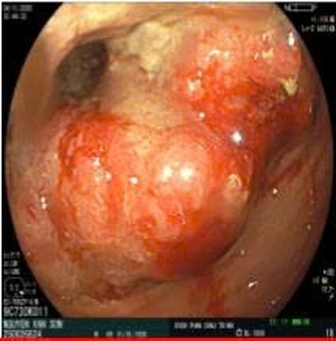 Phát hiện sớm ung thư đại tràng nhờ nội soi tại Bệnh viện ĐHYK Phan Châu Trinh - Ảnh 1.