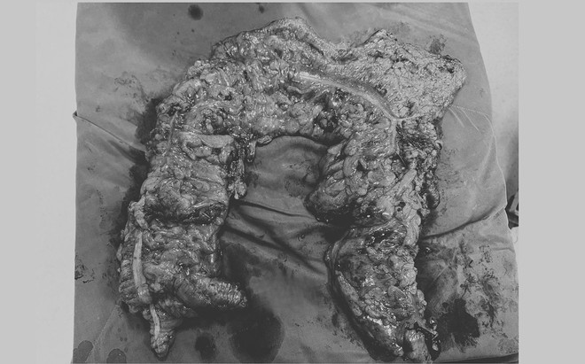 Nữ nội trợ U.70 t&aacute;o b&oacute;n suốt 10 năm phải cắt gần như to&agrave;n bộ đại tr&agrave;ng- Ảnh 3.