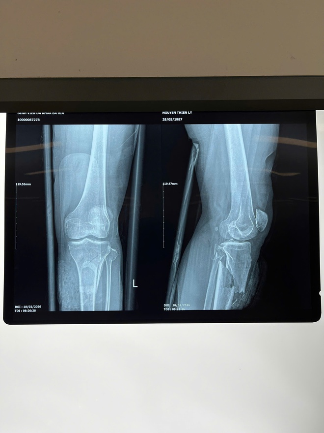 Phẫu thuật cứu b&agrave;n ch&acirc;n 3 tiếng cho người phụ nữ bị tai nạn giao th&ocirc;ng - Ảnh 2.