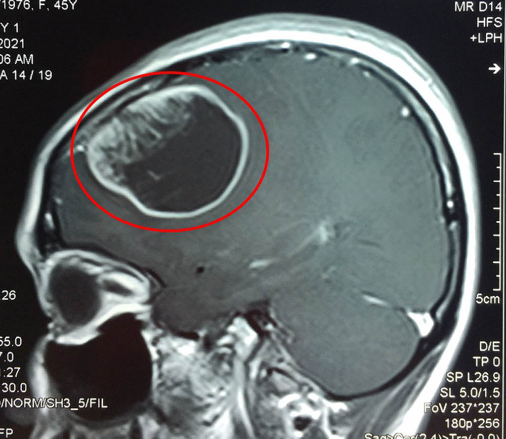 Nhớ trước quên sau, hóa ra có khối u não \'to như quả cam\' trong đầu