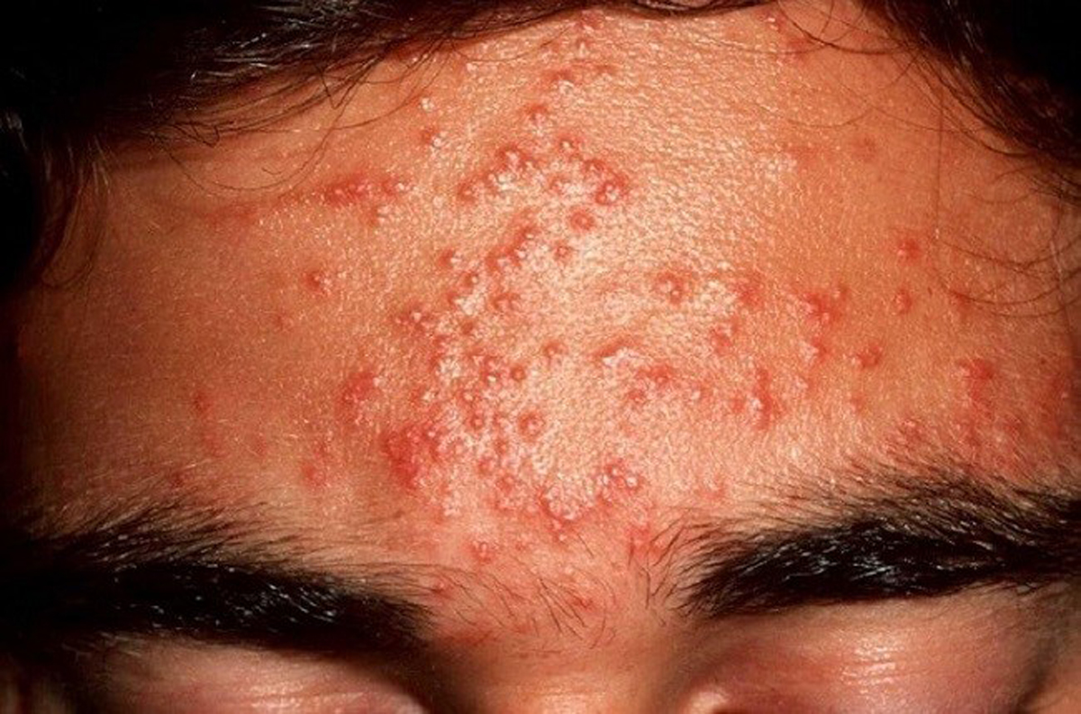 Trị mụn sai cách khiến mụn ngày càng nhiều hơn