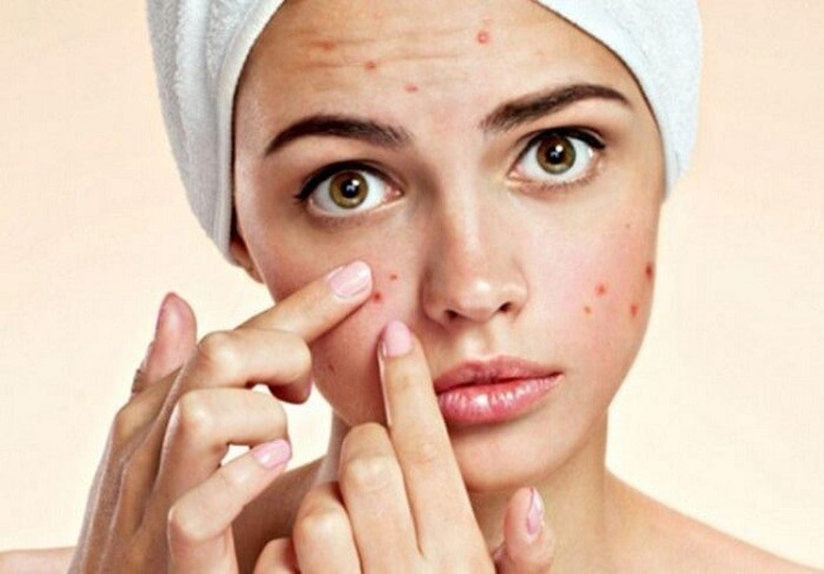 Sẹo rỗ, sẹo thâm là nguyên nhân gây mất thẩm mỹ da nghiêm trọng