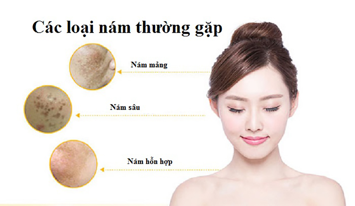 Review 10 kem trị nám, tàn nhang đang được chị em lựa chọn hiện nay