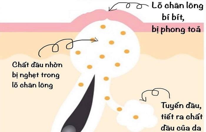 Cách trị mụn da dầu cách trị mụn da dầu Giải đáp và lời khuyên