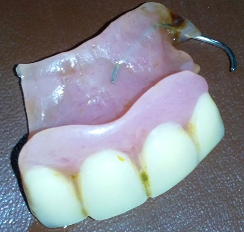Bị đau bụng, đi khám phát hiện cung răng giả trong dạ dày