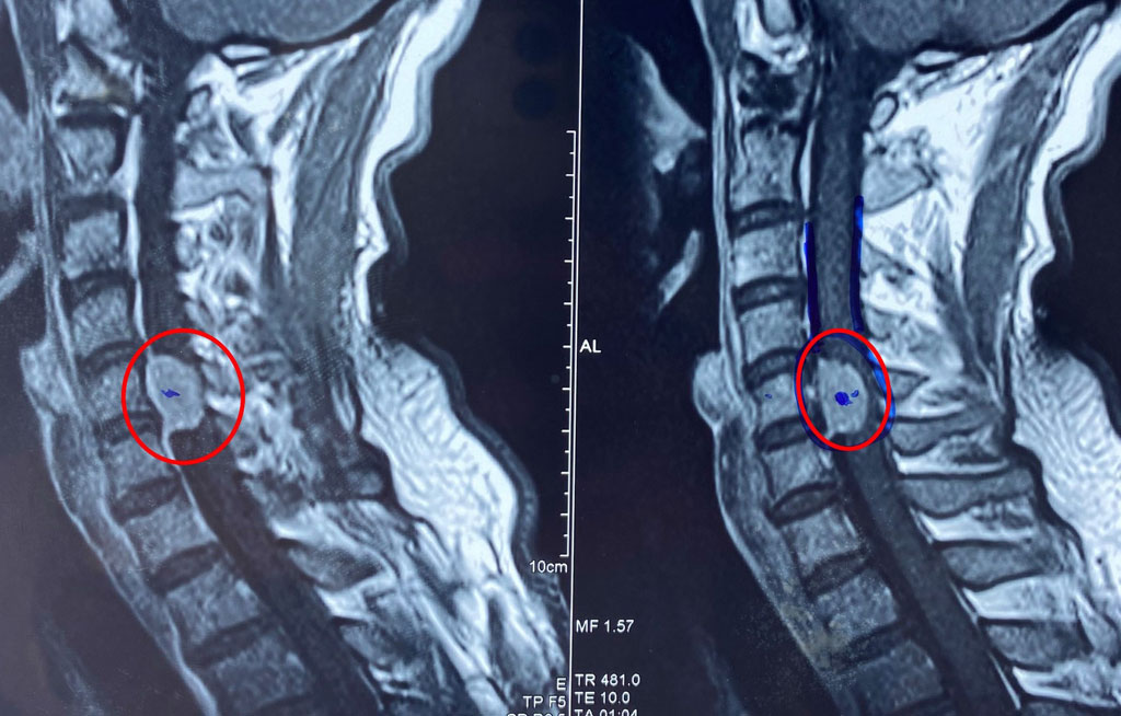 Đau cổ vai gáy đi khám phát hiện khối u chèn ép tủy