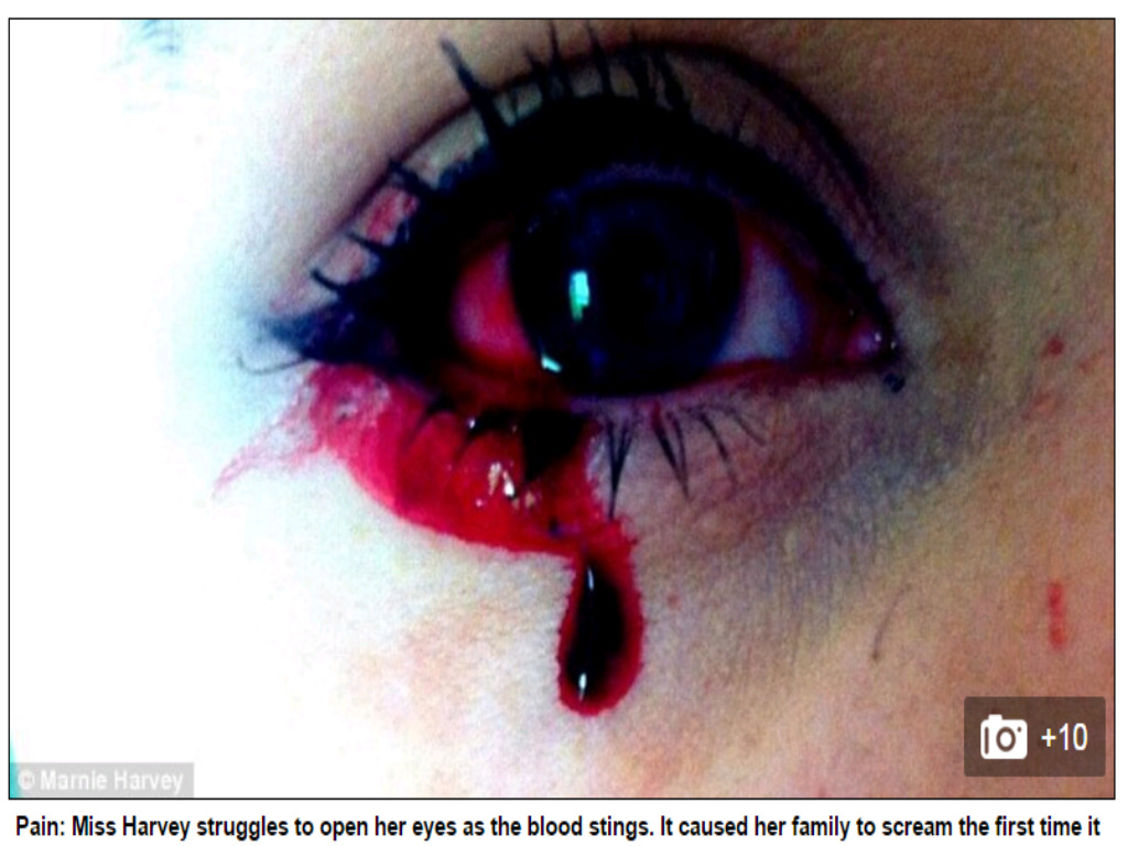 Cô gái bị bệnh lạ chảy máu mắt mỗi ngày