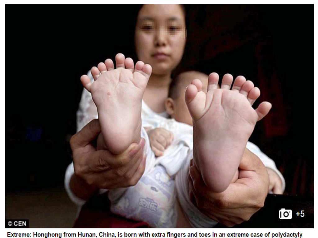 Bé trai có 15 ngón tay, 16 ngón chân ở Trung Quốc