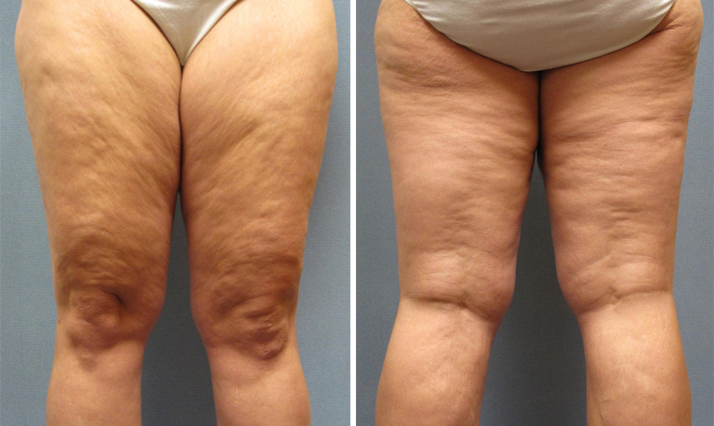 Cellulite là nỗi ám ảnh của phụ nữ, nó làm mất đi vẻ đẹp của vóc dáng lẫn làn da