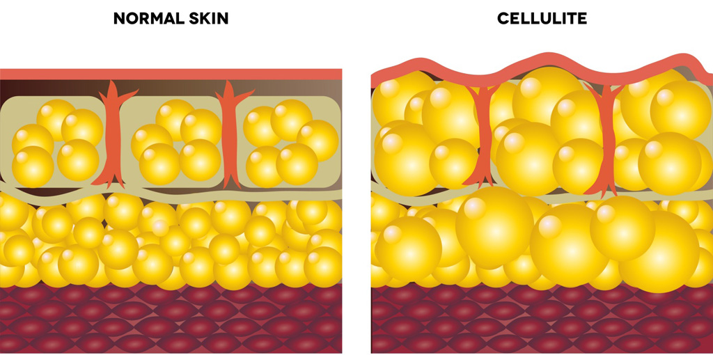 Collagen bị đứt gãy, các tế bào mỡ được giải phóng, phình to hơn gây nên Cellulite