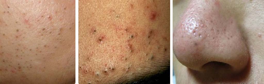 Blackheads if left untreated or in large quantities will enlarge pores