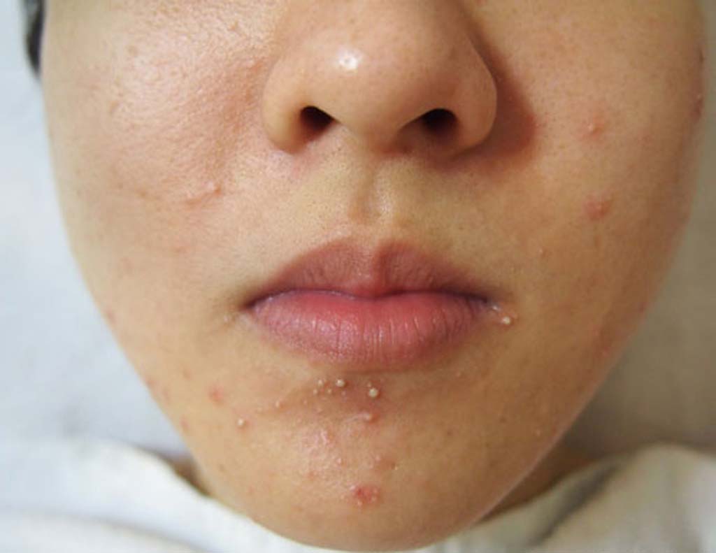 Pustules with relatively large pimple heads