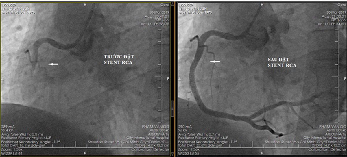 Mạch vành của bệnh nhân trước và sau khi đặt stent