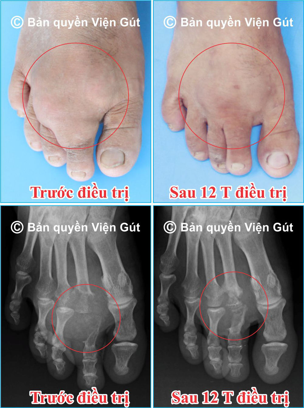 Kết quả điều trị khỏi bệnh gút của Viện Gút được công bố tại châu Âu