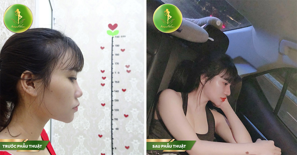 Gương mặt mũi thanh tú sau khoản thời gian nâng mũi cấu trúc