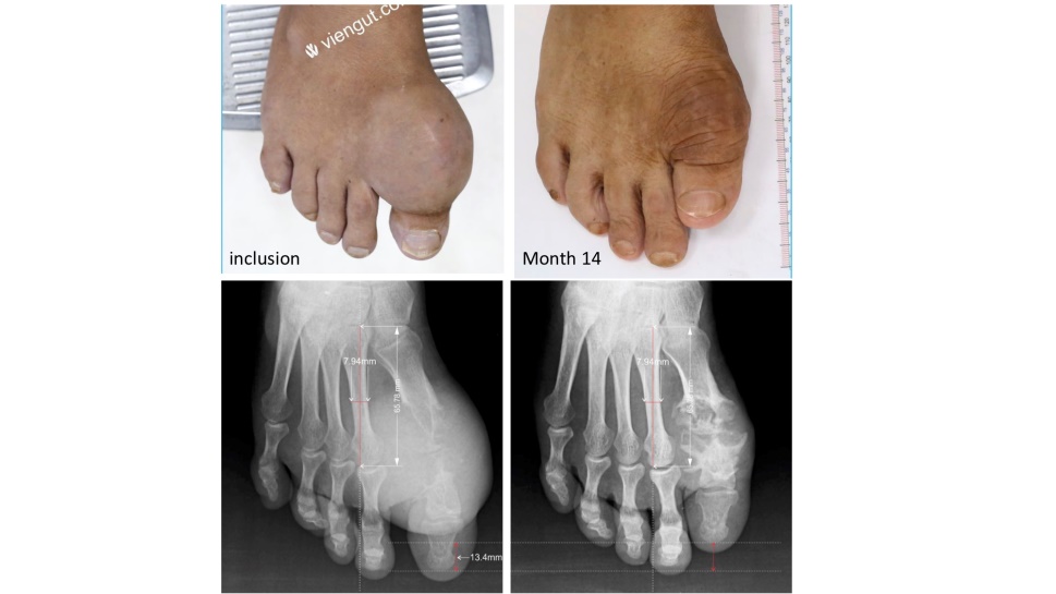 Hạt Tophi là gì Mổ hạt Tophi trên bệnh nhân bị bệnh Gout