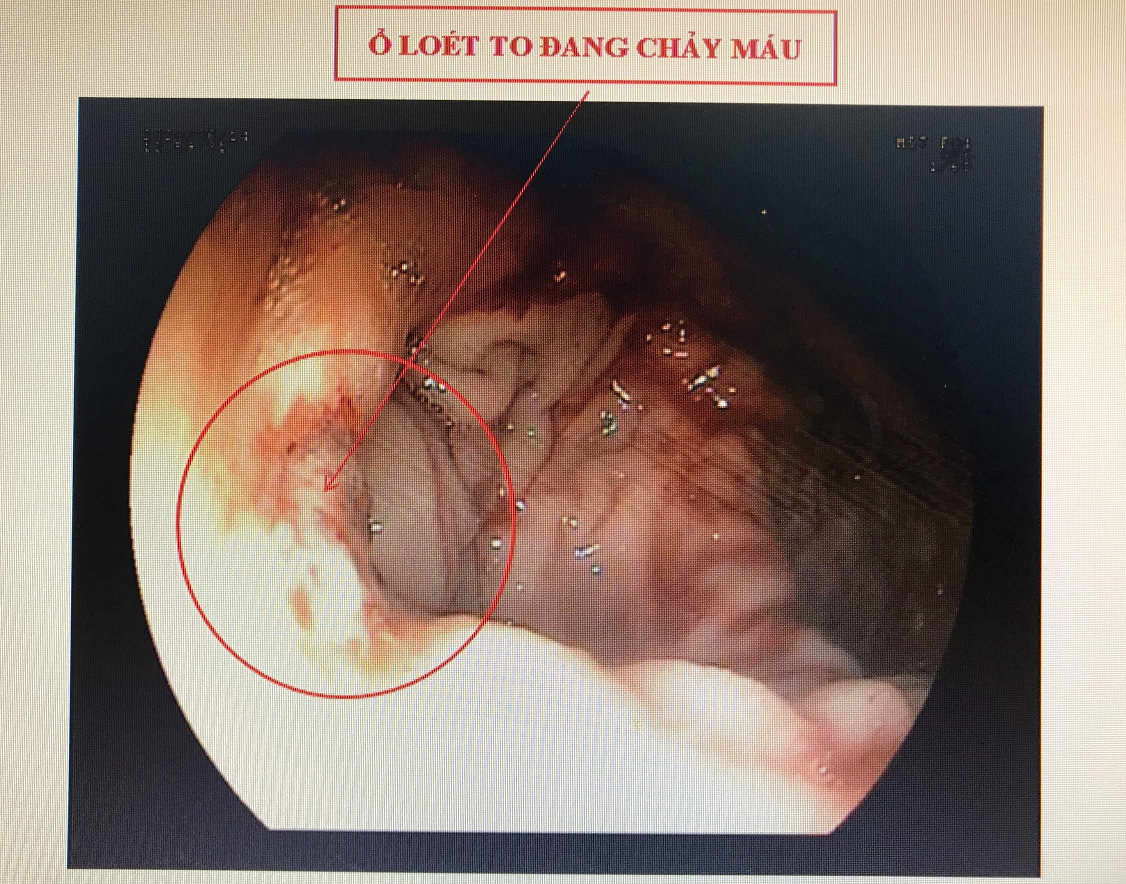 Cứu sống bệnh nhân xuất huyết tiêu hóa nguy kịch, máu phun thành tia