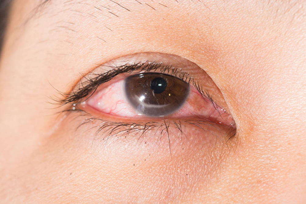 Cẩn trọng với bệnh đau mắt đỏ khi thời tiết giao mùa