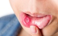 Ngày mới với tin tức sức khỏe: Loét miệng lâu lành có thể là dấu hiệu ung thư miệng