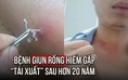 Bệnh giun rồng hiếm gặp 'tái xuất' tại Việt Nam sau hơn 20 năm: Cách để lấy giun khỏi cơ thể an toàn