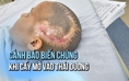 Khuyến cáo cấy mỡ vào thái dương gây biến chứng đột quỵ não