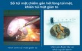 Phát hiện sỏi túi mật lớn gần bằng quả trứng gà khi khám sức khỏe định kỳ
