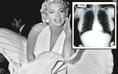 Ảnh X-quang của Marilyn Monroe gây phẫn nộ khi bị đấu giá