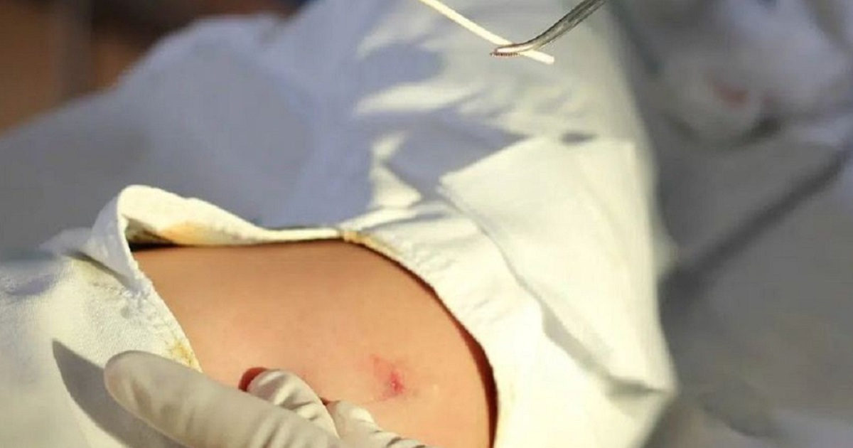 Hy hữu: Cô gái cấy que tránh thai ở tay, không ngờ que đi vào tim